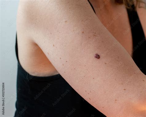 melanoma on the arm